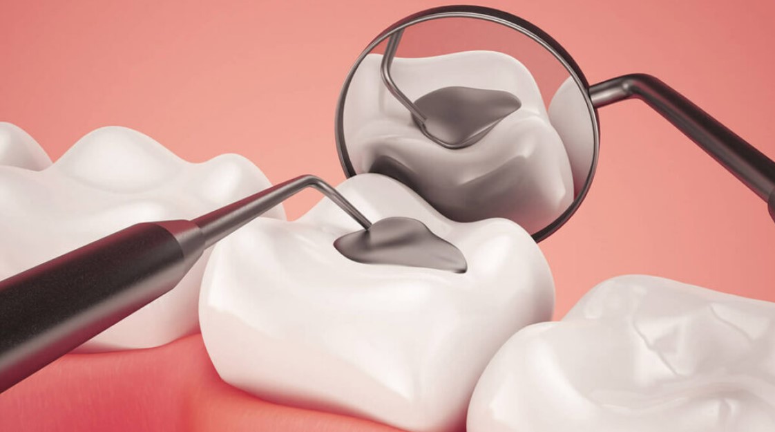 Зубная боль под пломбой: причины и решения