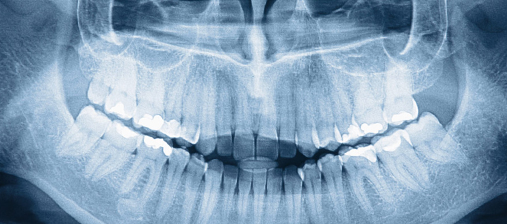 Рентген зубов: как проводится, преимущества и противопоказания ▶️eirc-ram.ru